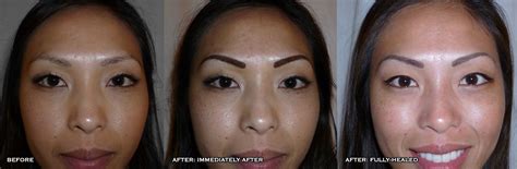 Permanent Makeup San Diego Artistry Of Permanent Makeup Before