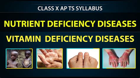 Vitamin Deficiency Diseases Class 10th Nutrition Biology Science