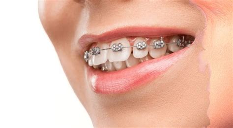 What Are Dental Braces Types Cost And Procedure Udento Dental