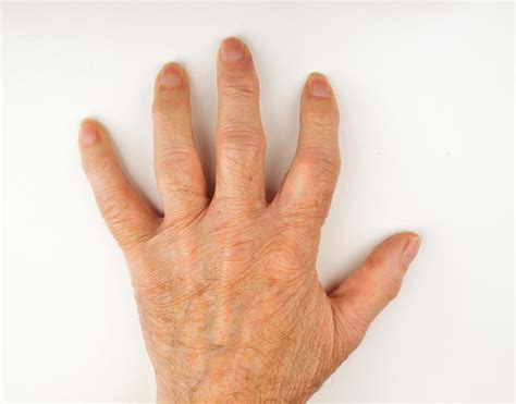 Rheumatoid Arthritis Bumps On Fingers
