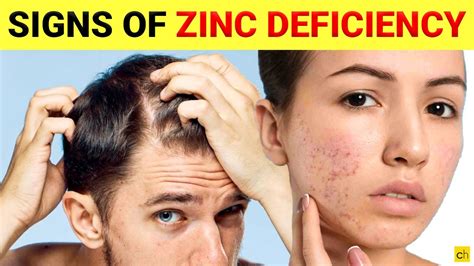 Do You Know These 7 Shocking Signs Of Zinc Deficiency Credihealth