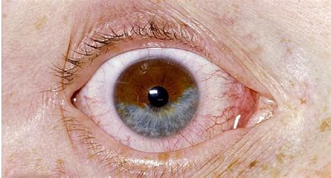 Slideshow Unusual Eye Conditions Webmd Rare Eyes Beauty Video