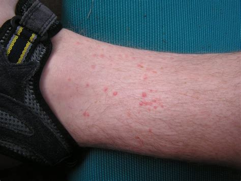 Chiggers Bites Pictures