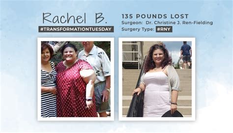 Before And After Rny With Rachel B Losing 135 Pounds Obesityhelp