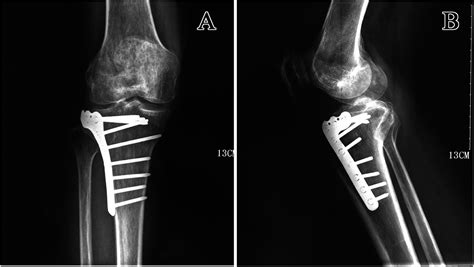 3d Printing Assisted Osteotomy Treatment For The Malunion Of Lateral