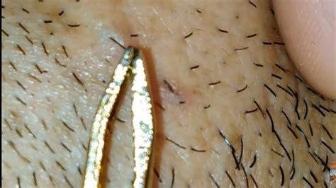 Perhaps that's why there's an instagram account called tweezist that's completely devoted to the removal of ingrown hairs. Largest ingrown hair removal on face - YouTube
