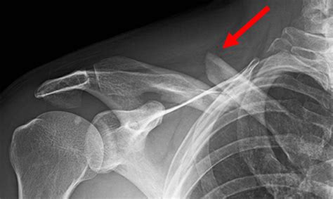 Clavicle Fracture Broken Collarbone Orthopaedic Trauma Association