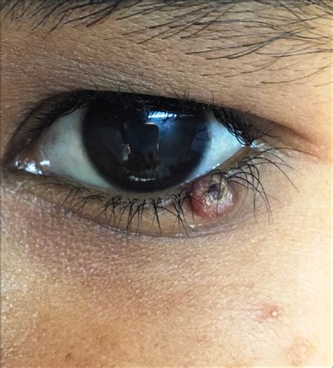 Congenital Asymptomatic Papule On The Lower Eyelid Indian Journal Of