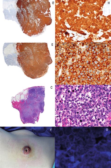 Alk Positive Primary Cutaneous Anaplastic Large Cell Lymphoma A