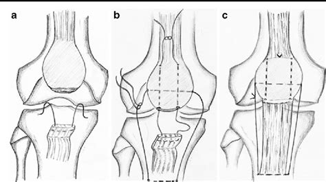 Patellar Tendon Rupture Repair