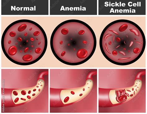 Sickle Cell Vs Normal Cell