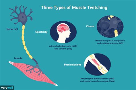 Muscle Twitches Ms And Other Possible Causes