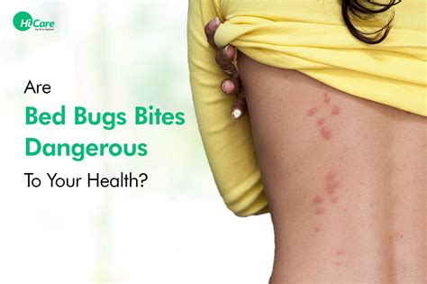 Bed Bugs Bite Everything About Bed Bugs Bite Treatment Hicare