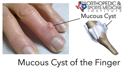 Mucous Cyst Of The Finger Diagnosis And Treatment
