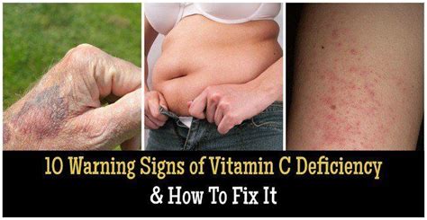 10 Warning Signs Of Vitamin C Deficiency How To Fix It Vitamin C