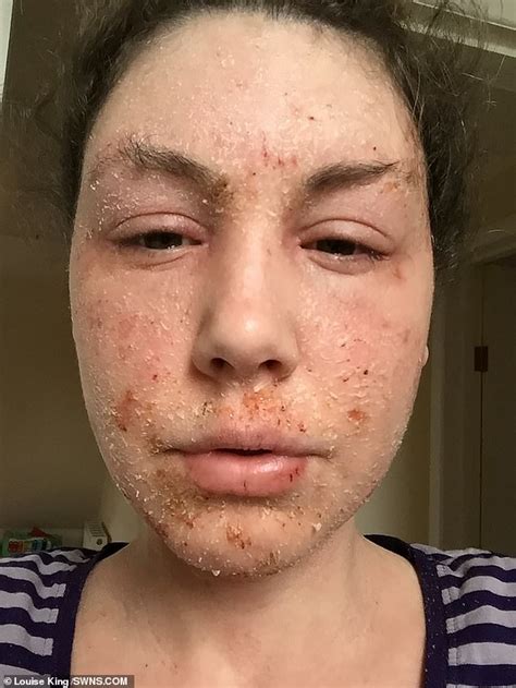 Woman Has Lizard Skin After Ditching Steroid Creams For Eczema