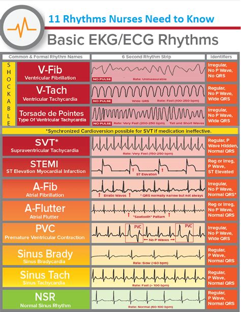 Chart Of Heart Rhythms