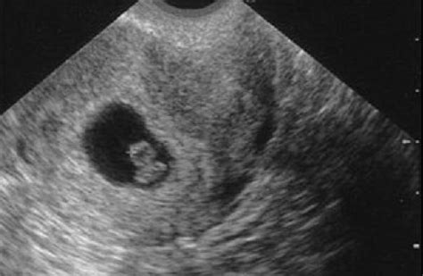 7th Week Of Pregnancy Ultrasound Pregnancywalls