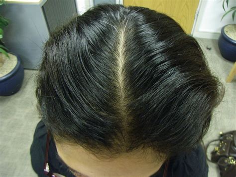 Chemotherapy, when used to treat cancer in toddlers, can lead to hair loss. The Hair Centre | Female Hair Loss In A 25 Year Old (See ...