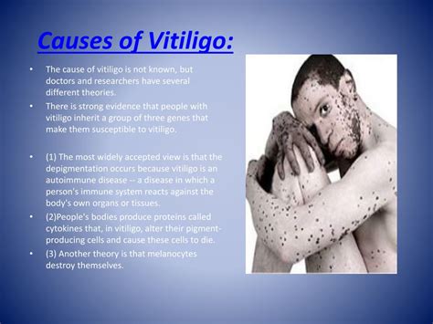 Ppt Vitiligo By Linna And Haley