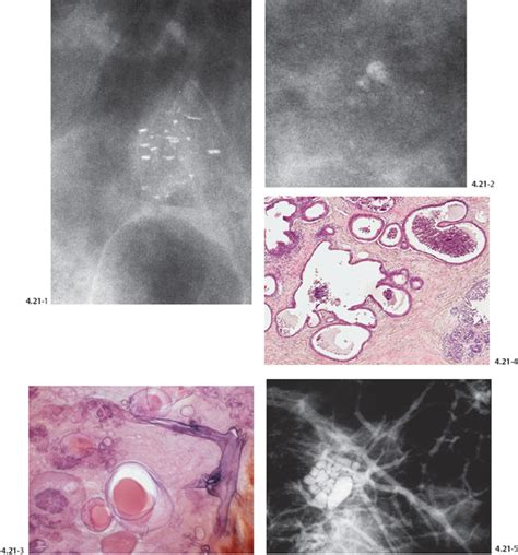Differential Diagnosis Of Breast Diseases Producing Clustered
