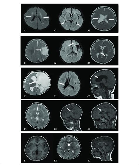 Cranial Mri Findings Of The 18 Patients In The St Group A12