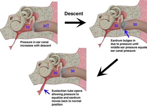 Eustachian Tube Dysfunction Ear Pressure Eustachian Tube Dysfunction