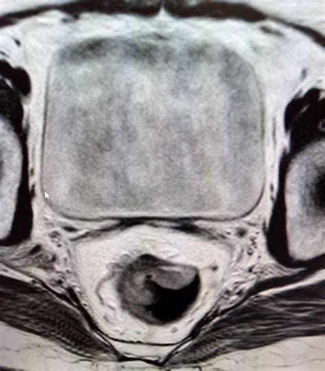 Carcinoma Rectum Mri Sumer S Radiology Blog