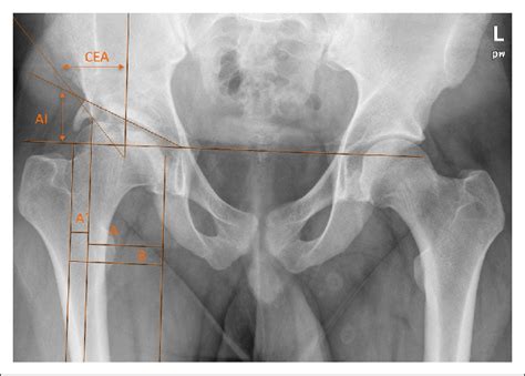 Postoperative Radiograph And Radiographic Measurements 10 Years After