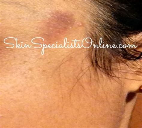 Fungal Infection On Face Skin Specialists Online