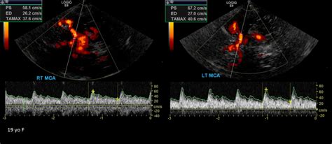 Transcranial Doppler Medical Ultrasound Vascular Ultrasound Ultrasound