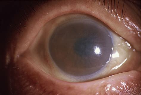 Figure 1 From Toxic Anterior Segment Syndrome After Cataract Surgery Semantic Scholar