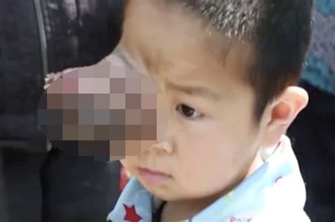 Shocking Video Shows Giant Tumour On Poor Boys Face And It Cant Be