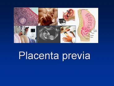 Ppt Placenta Previa Powerpoint Presentation Free To View Id