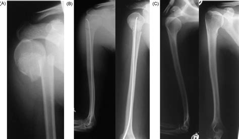 Treatment of severely displaced proximal humeral fractures in children with retrograde elastic ...