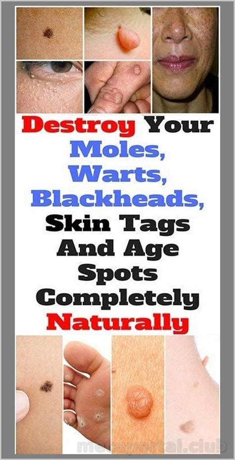 How To Remove Moles Warts Blackheads Skin Tags And Age Spots