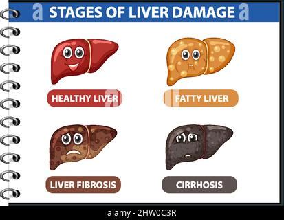 Diagrama que muestra las etapas de daño hepático debido a la cirrosis