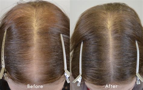 Female hair loss can include: 5mg Finasteride For Female Hair Loss - Hair Restoration of ...