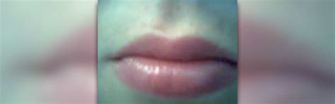 White Bumps On Lips General Center