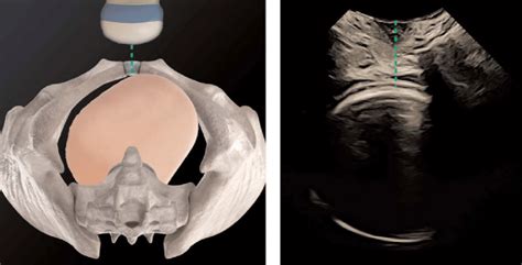 Comparative Simulated Image With Transperineal Ultrasound Depicting