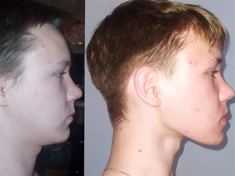 Mewing Before And After Results 70 Crazy Transformations