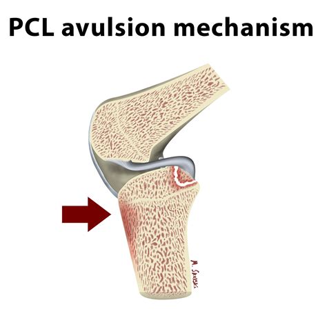 PCL Avulsion Fracture Image Radiopaedia Org