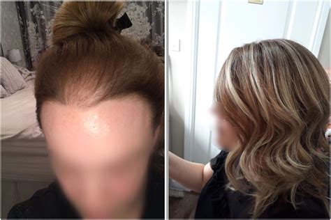 Female Hair Loss On The Crown And Around The Front Hairline