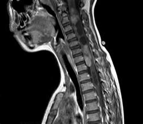 Spinal Cancer Xray Cancerwalls