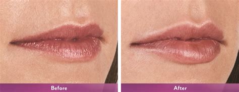 Juvederm Volbella® Xc Is One Of The Most Recent Additions To The