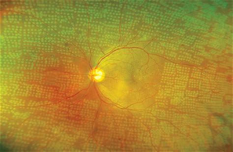 Proliferative Diabetic Retinopathy Laser Or Eye Injection The Lancet