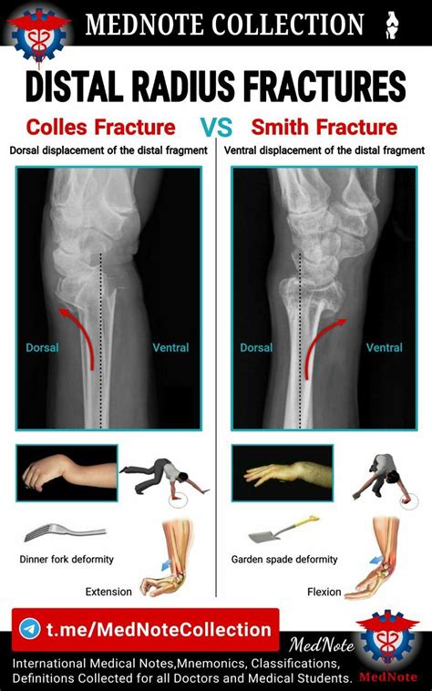 Distal Radius Fractures Colles Fracture Vs Smith Fracture In 2021