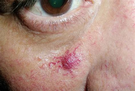 Spider Angioma Picture Image On