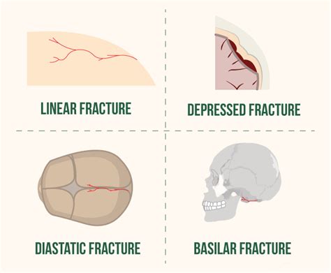 Simple Skull Fracture