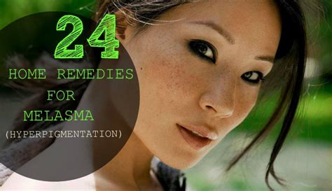 24 Home Remedies For Melasma Home Remedies Natural And Herbal Cures